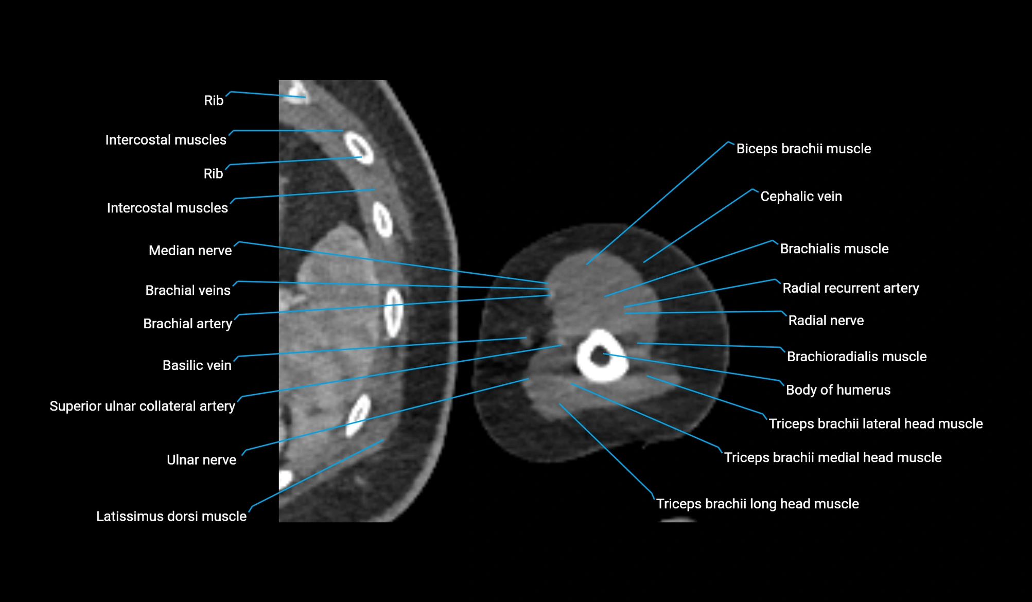 CT upper arm axial  cross sectional anatomy labelled radiology image -00314.webp